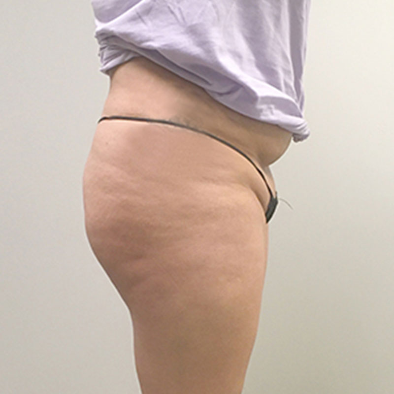 Non Surgical Brazilian Butt Lift 03
