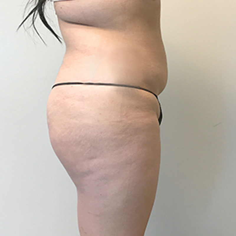 Non Surgical Brazilian Butt Lift 03