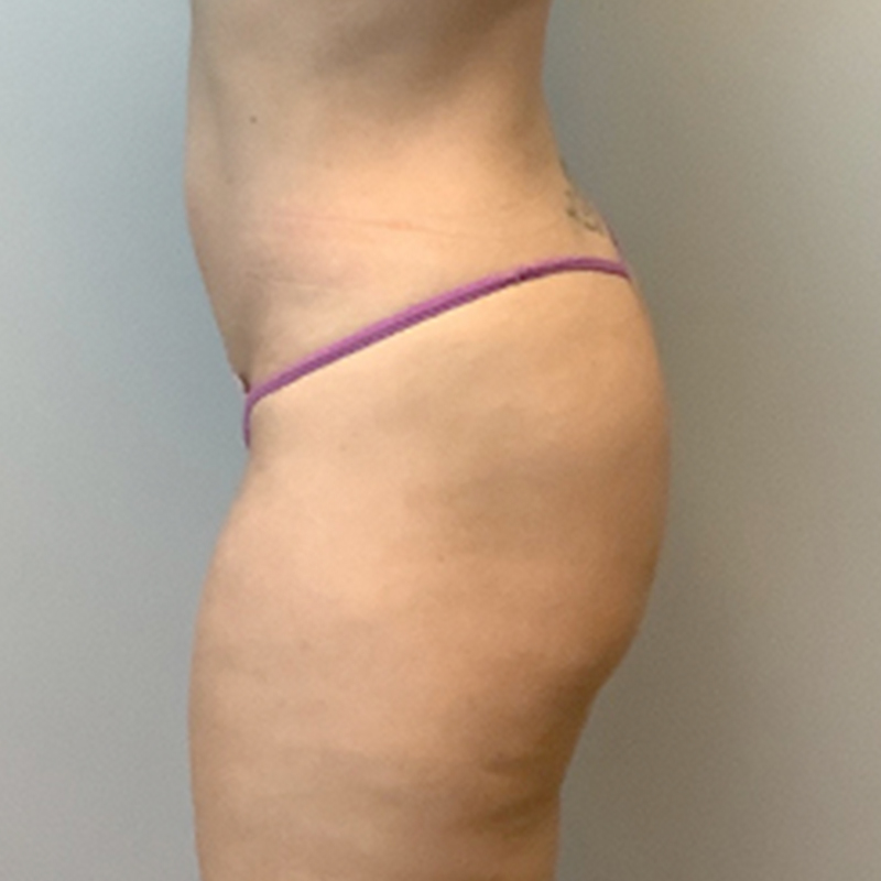Non Surgical Brazilian Butt Lift 05
