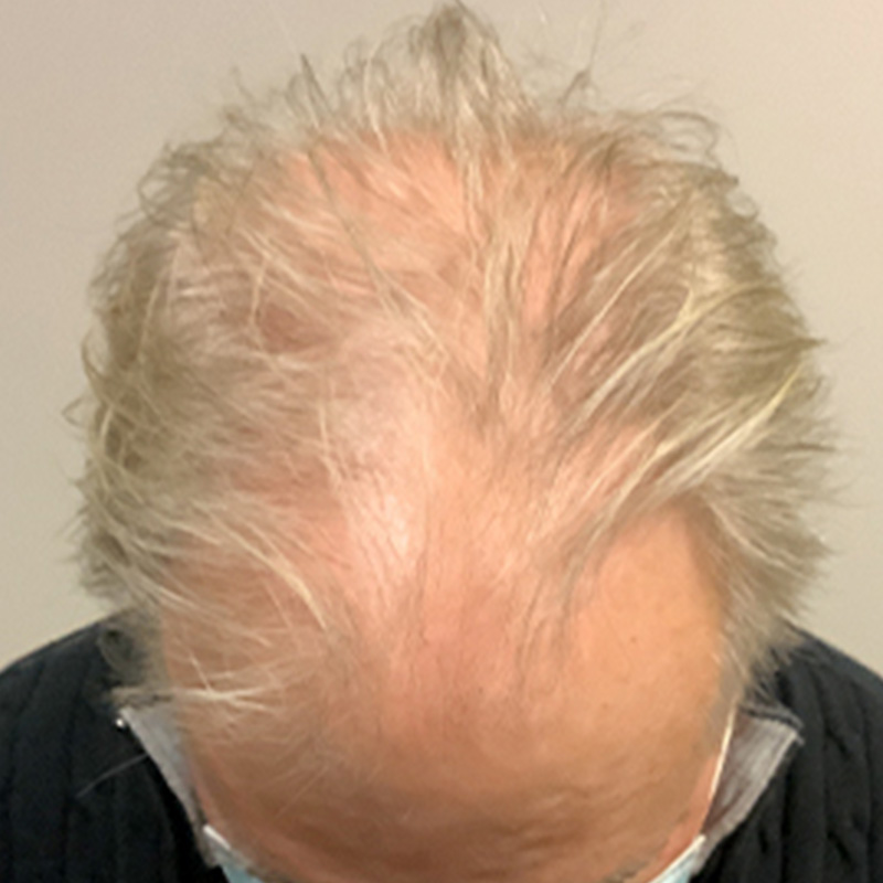 Non Surgical Hair Restoration 01