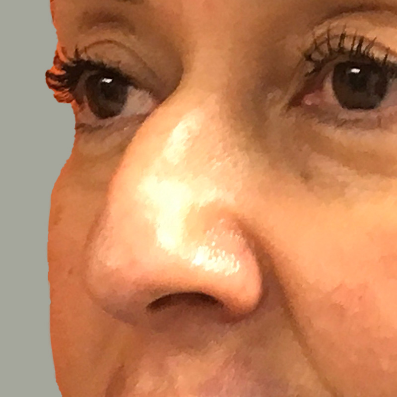 Non Surgical Rhinoplasty 03