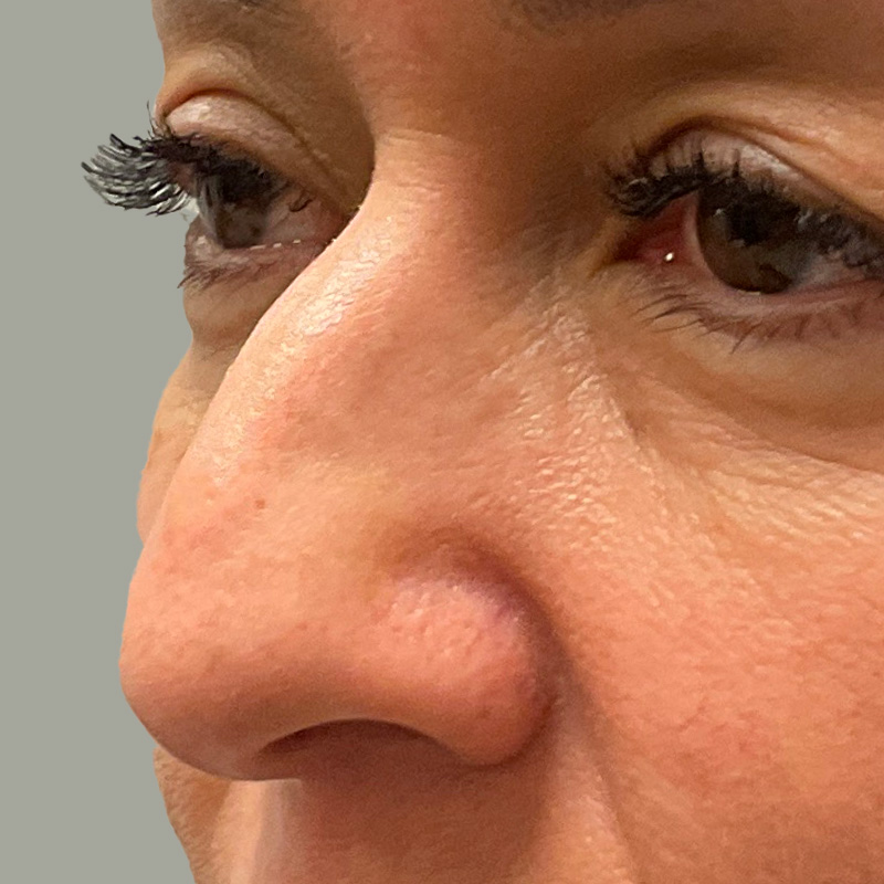 Non Surgical Rhinoplasty 03