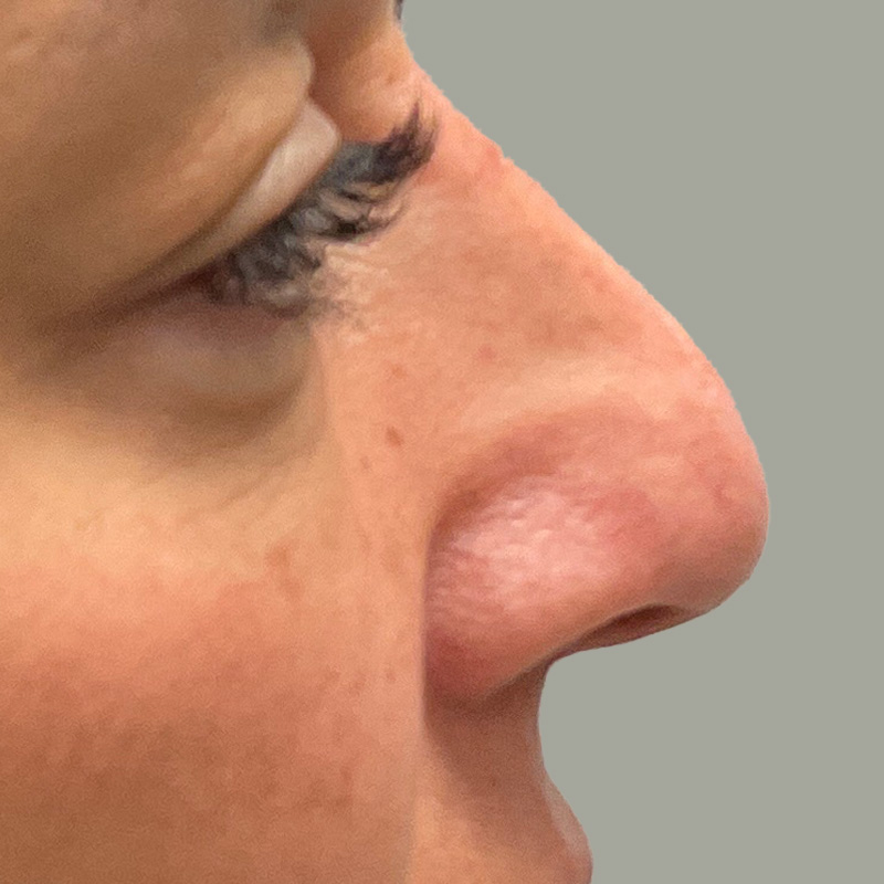 Non Surgical Rhinoplasty 07