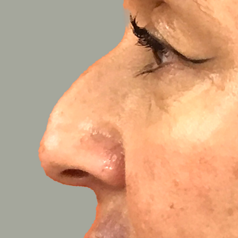 Non Surgical Rhinoplasty 09