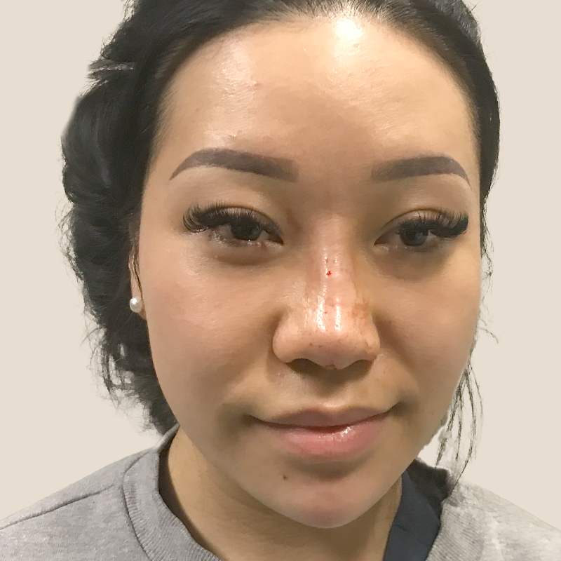 Non Surgical Rhinoplasty 02