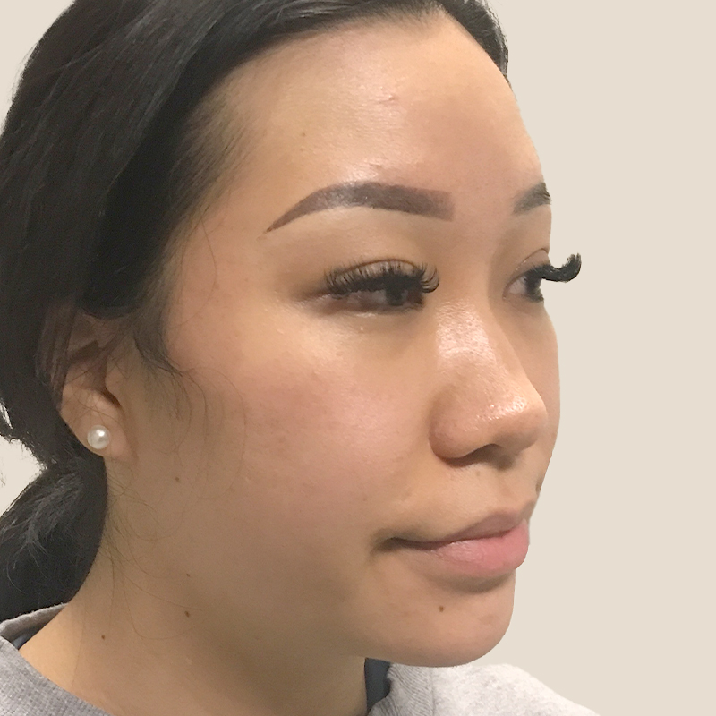 Non Surgical Rhinoplasty 03