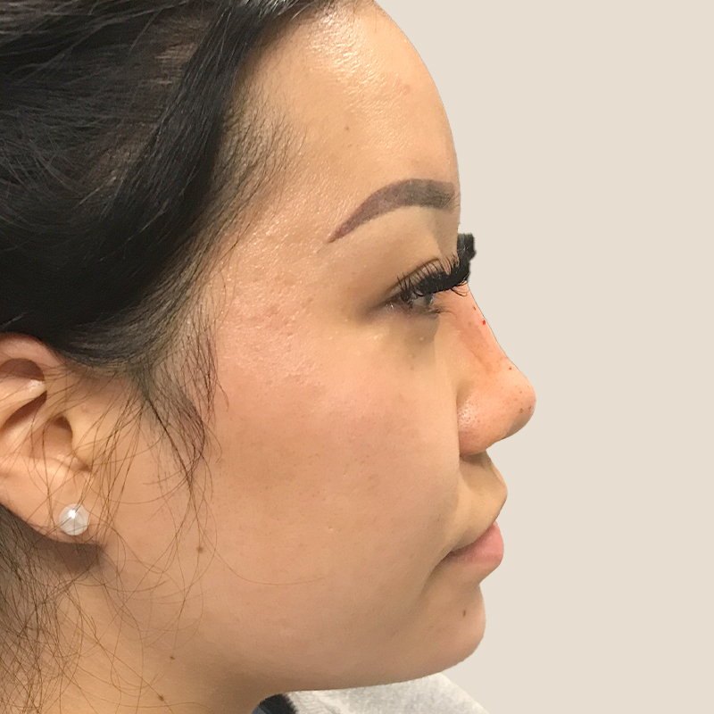 Non Surgical Rhinoplasty 05