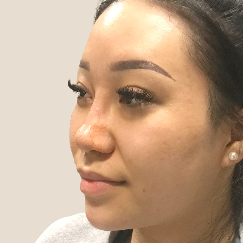 Non Surgical Rhinoplasty 07