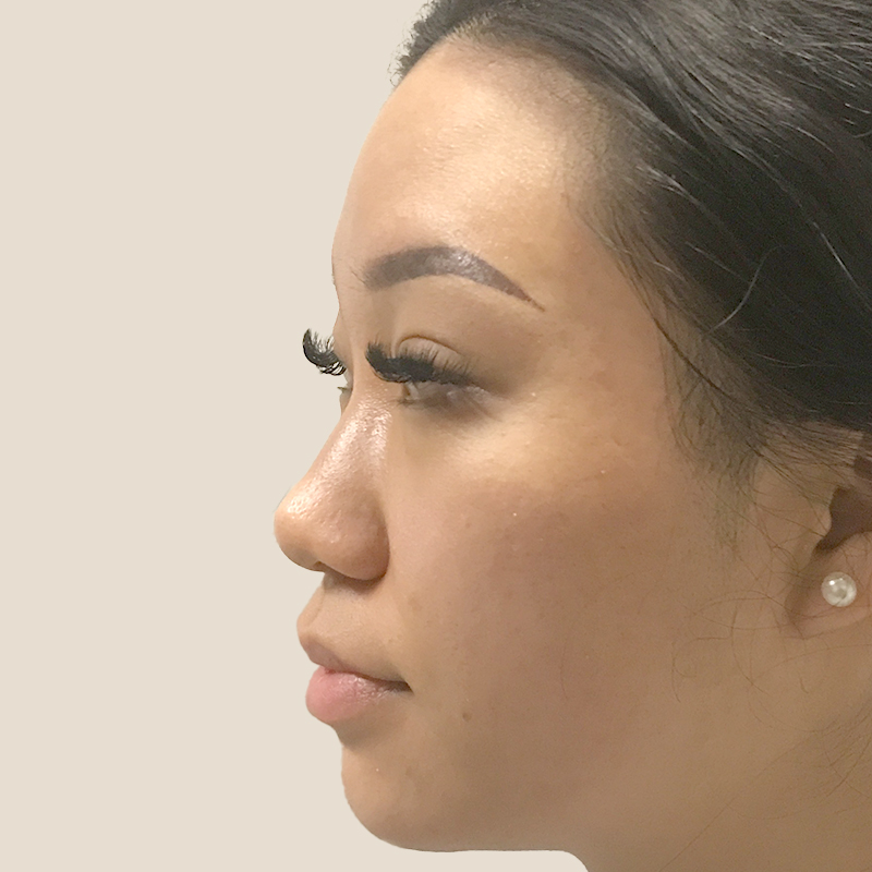 Non Surgical Rhinoplasty 09