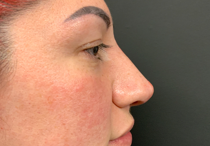 Non Surgical Rhinoplasty 03