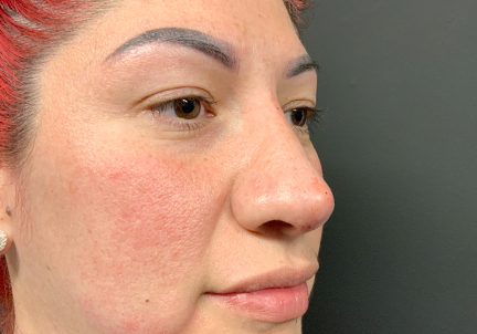 Non Surgical Rhinoplasty 03