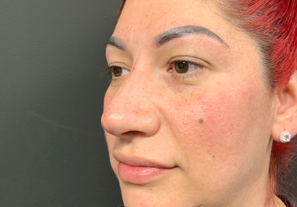 Non Surgical Rhinoplasty 05