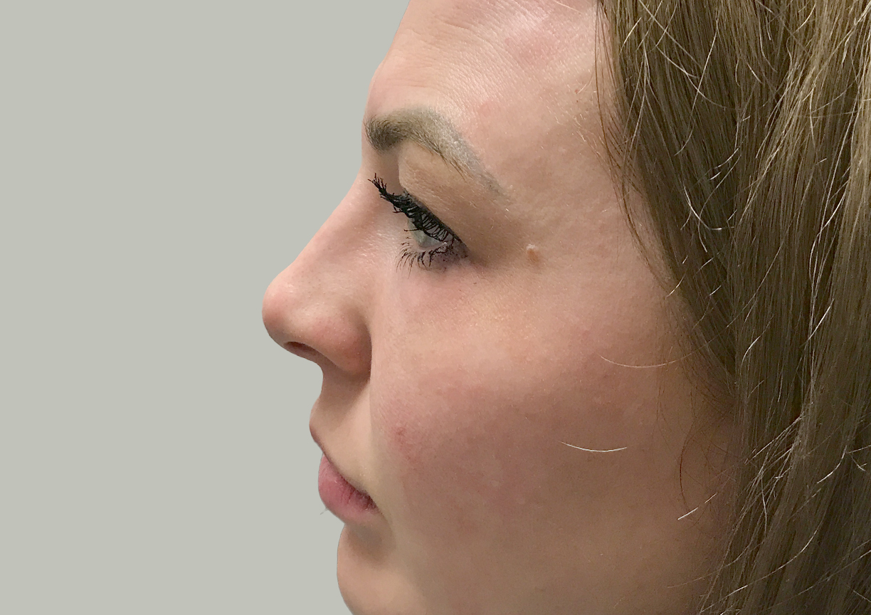 Non Surgical Rhinoplasty 03