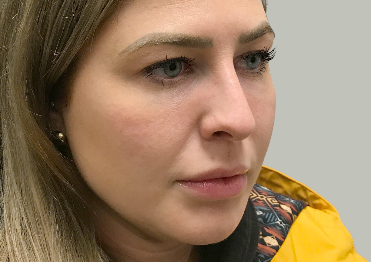 Non Surgical Rhinoplasty 07