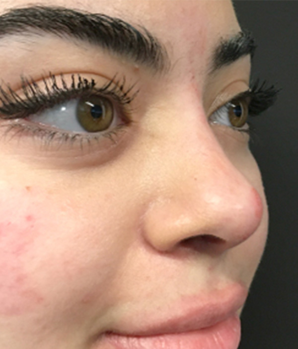 Non Surgical Rhinoplasty 05