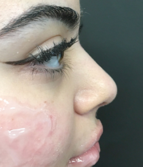 Non Surgical Rhinoplasty 03