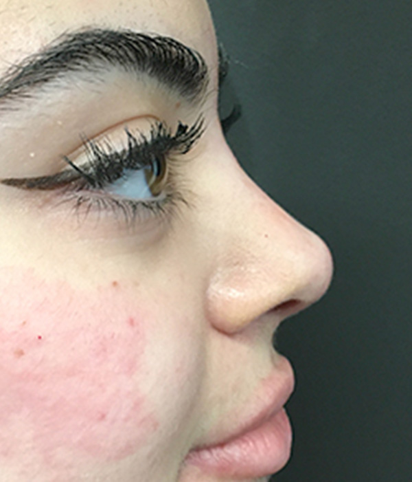 Non Surgical Rhinoplasty 03