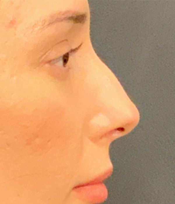 Non Surgical Rhinoplasty 01