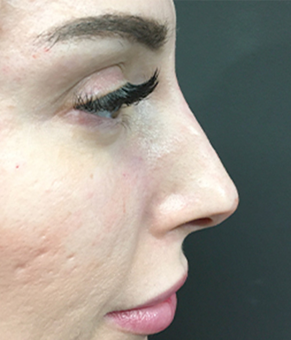 Non Surgical Rhinoplasty 06