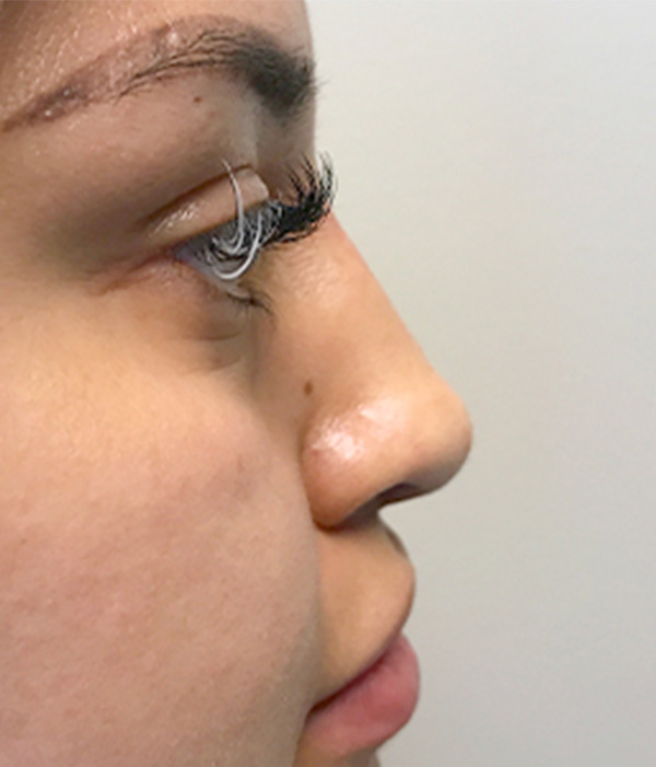 Non Surgical Rhinoplasty 07