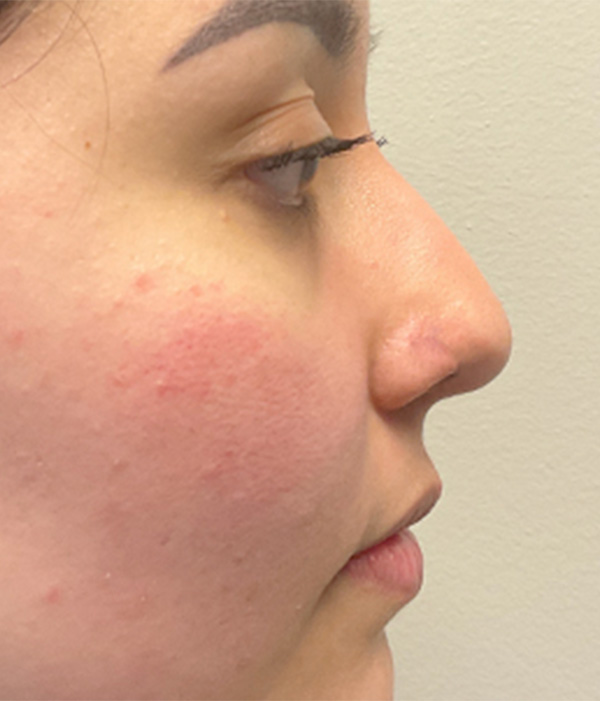 Non Surgical Rhinoplasty 01