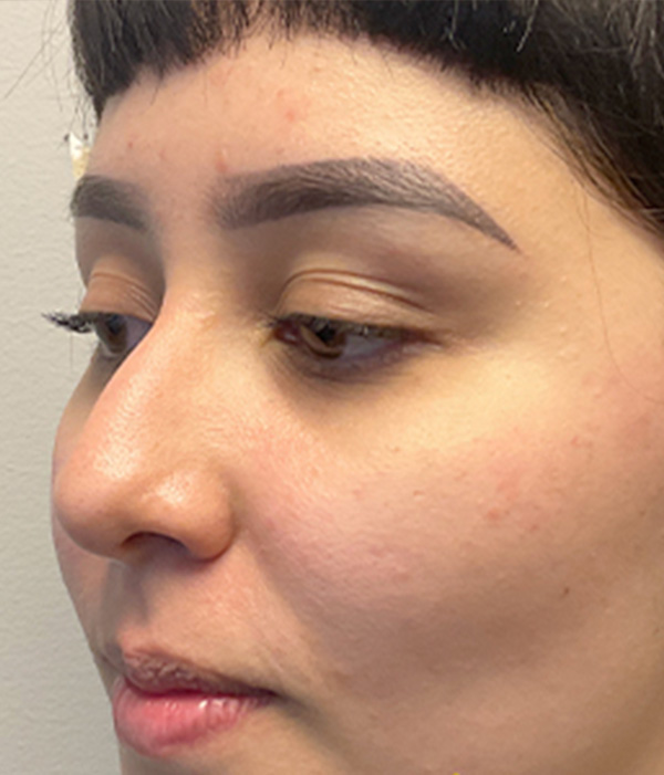 Non Surgical Rhinoplasty 05