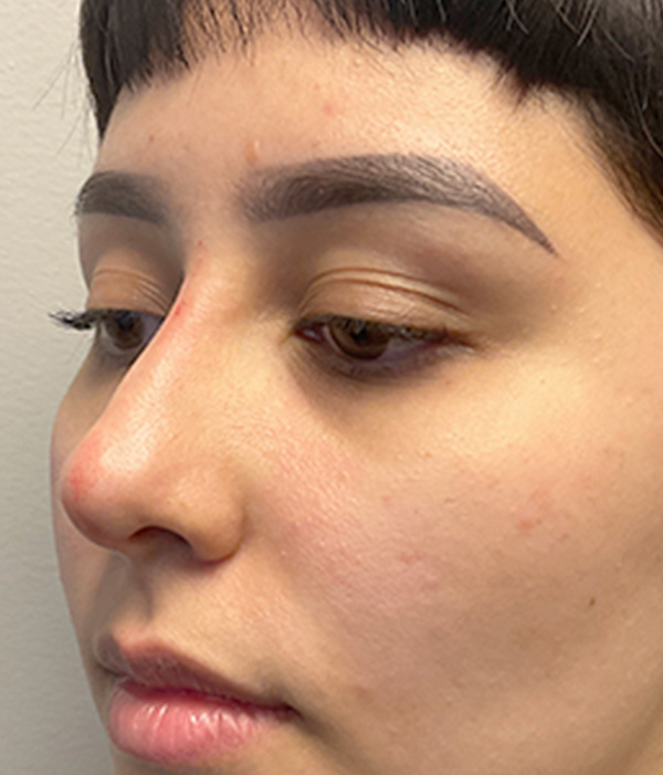 Non Surgical Rhinoplasty 05