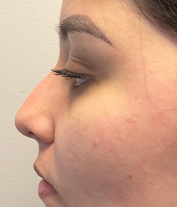 Non Surgical Rhinoplasty 07