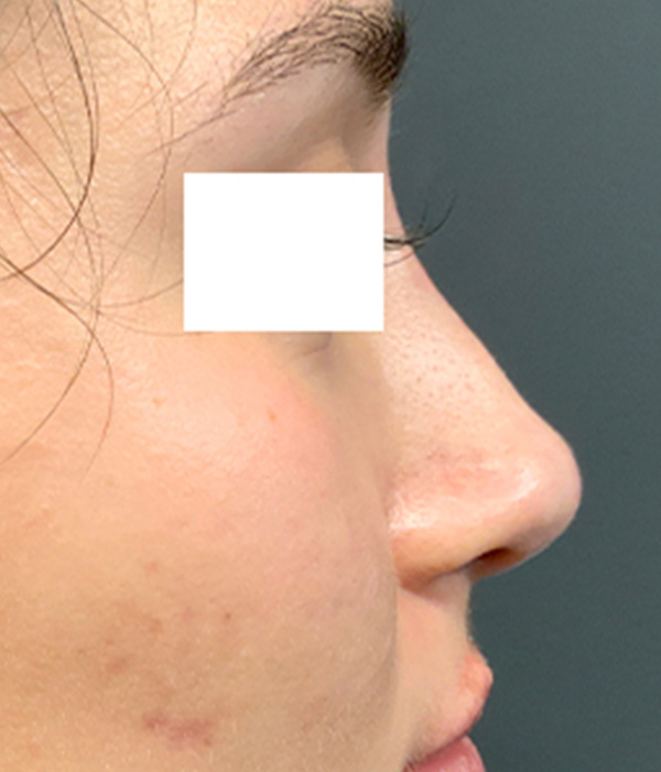 Non Surgical Rhinoplasty 09