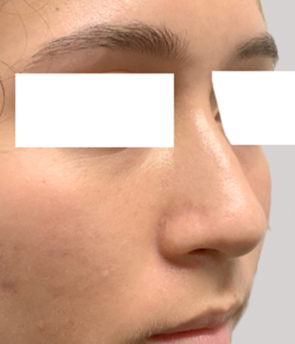 Non Surgical Rhinoplasty 03
