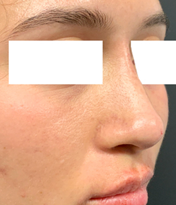 Non Surgical Rhinoplasty 03