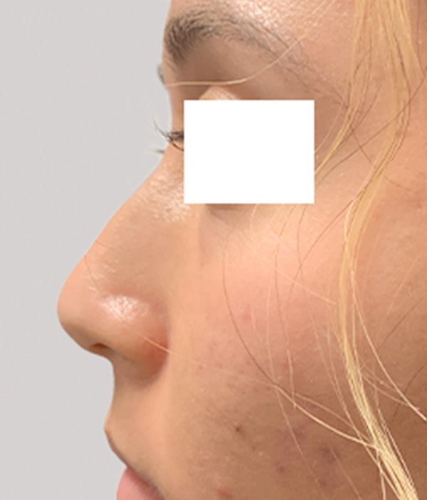 Non Surgical Rhinoplasty 05