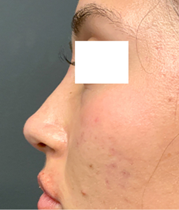 Non Surgical Rhinoplasty 05