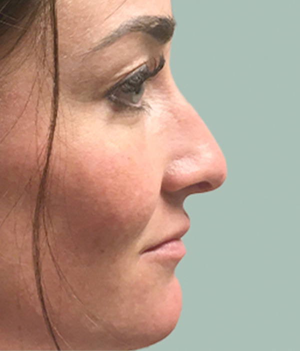 Non Surgical Rhinoplasty 01