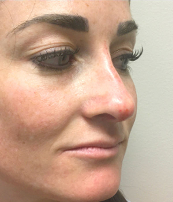 Non Surgical Rhinoplasty 03