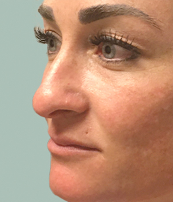 Non Surgical Rhinoplasty 05