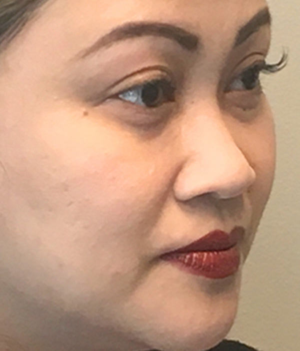 Non Surgical Rhinoplasty 05