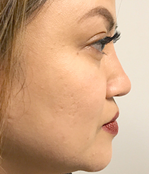 Non Surgical Rhinoplasty 07