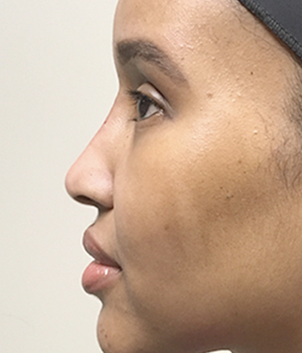 Non Surgical Rhinoplasty 12