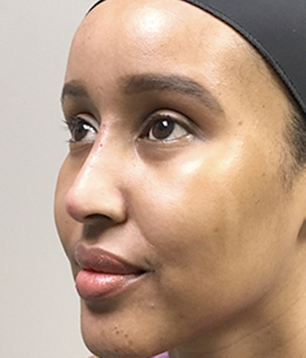 Non Surgical Rhinoplasty 03