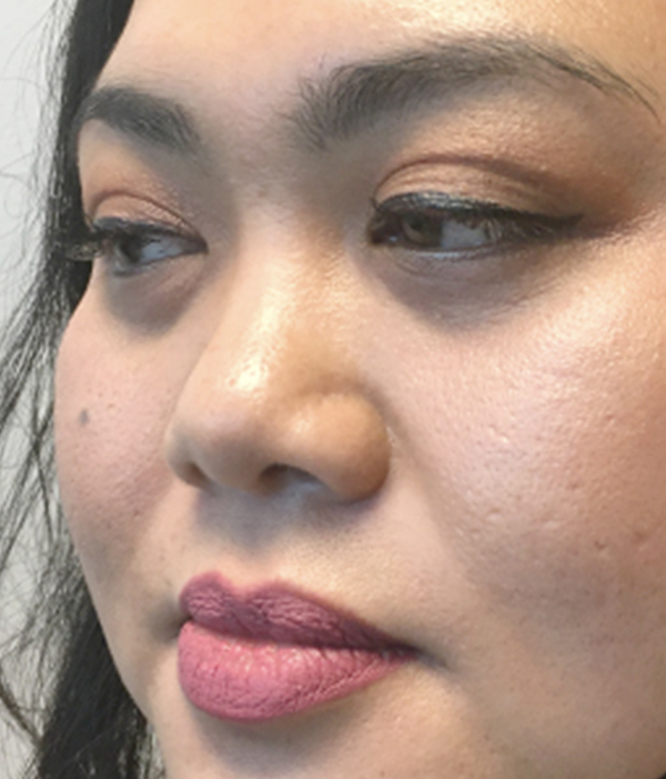 Non Surgical Rhinoplasty 03