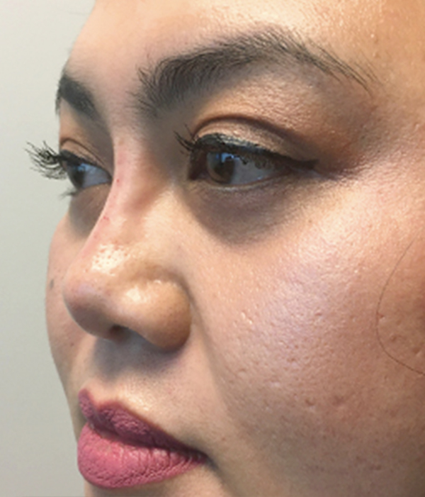 Non Surgical Rhinoplasty 03