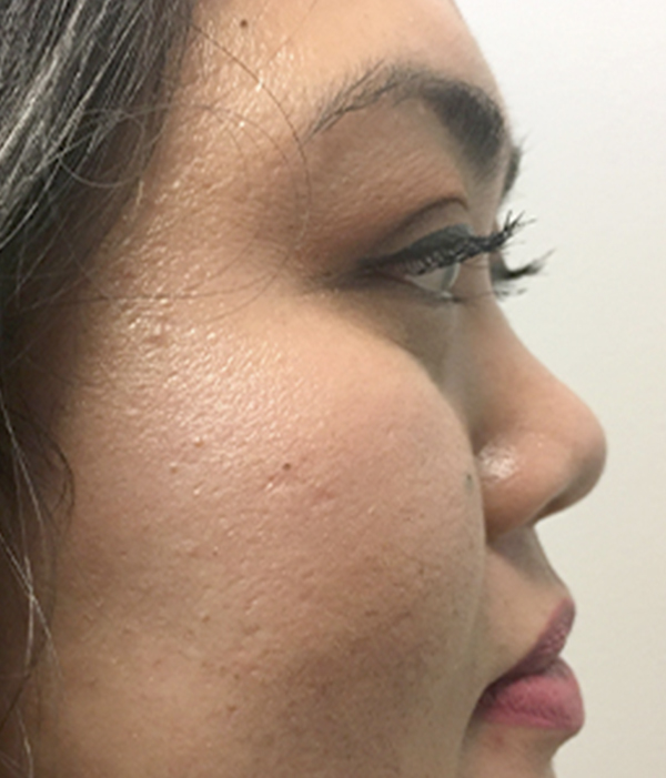 Non Surgical Rhinoplasty 05