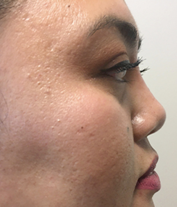 Non Surgical Rhinoplasty 05