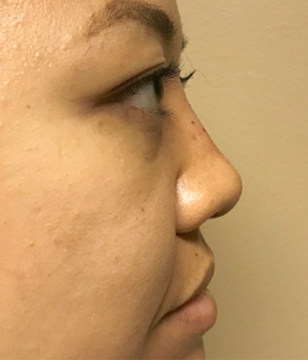 Non Surgical Rhinoplasty 03