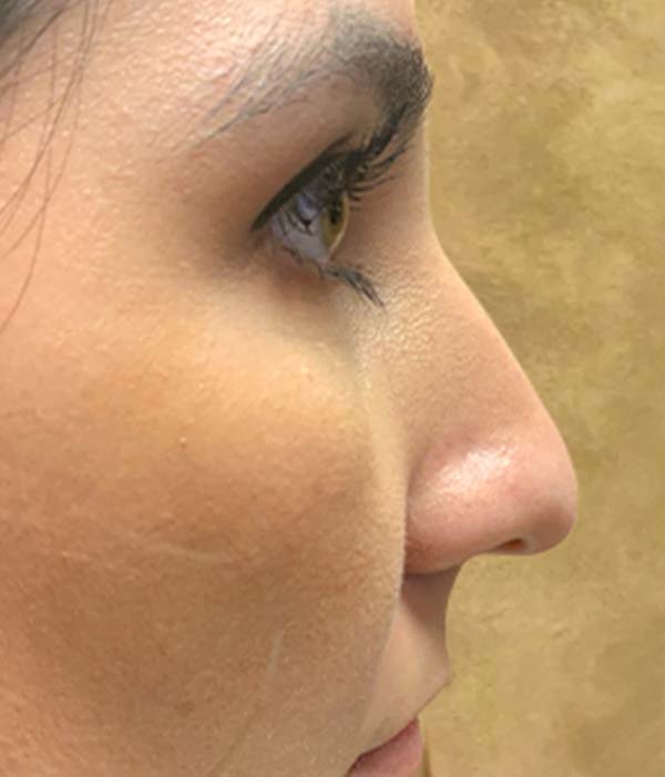 Non Surgical Rhinoplasty 05