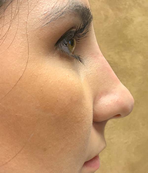 Non Surgical Rhinoplasty 05