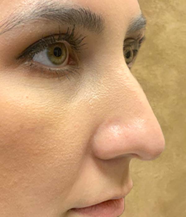 Non Surgical Rhinoplasty 07
