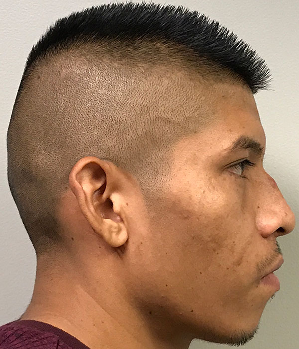 Non Surgical Rhinoplasty 01