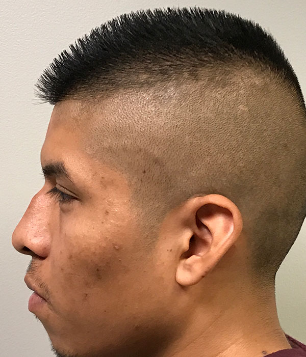 Non Surgical Rhinoplasty 03